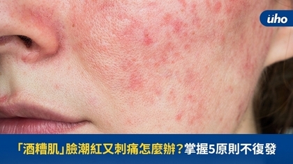 「酒糟肌」臉潮紅又刺痛怎麼辦?掌握5原則不復發