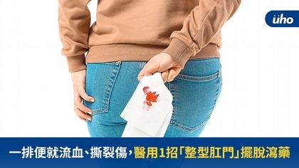 一排便就流血、撕裂傷,醫用1招「整型肛門」擺脫瀉藥