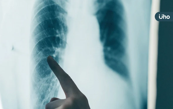 肺腺癌致癌機轉找到了！研究揭「防腐劑、汽機車廢氣」都是元兇之一