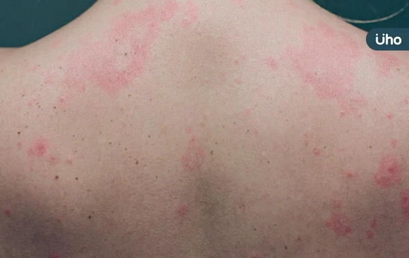 蕁麻疹皮膚癢又腫，不吃藥會自己好？醫揭「這類型」與免疫失調有關