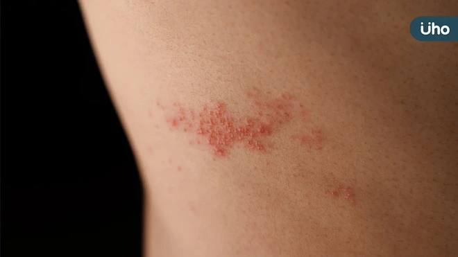 帶狀疱疹後神經痛難纏 中醫4大食療方對症調理