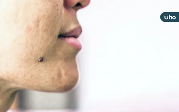 臉上突長黑斑，恐是皮膚癌徵兆！醫揪「基底細胞癌 」好發曝曬部位