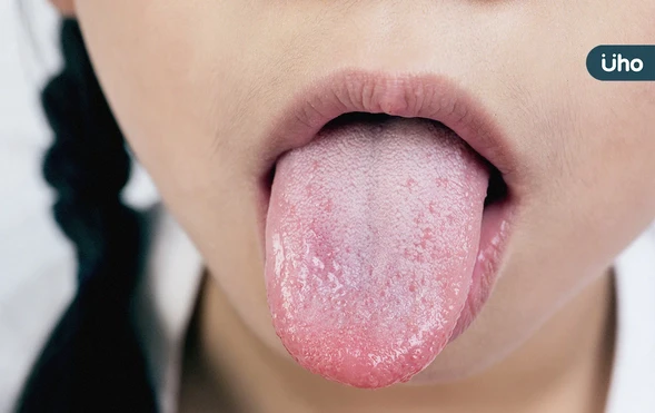舌苔黃正常嗎？需要每天刷？「黃、灰黑、厚白⋯」8種舌象自我檢測