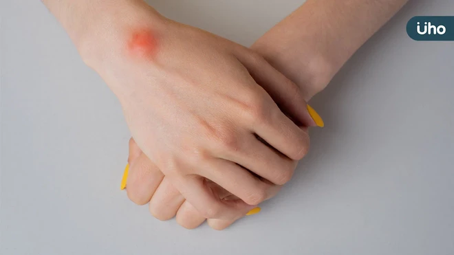 手腕腫塊別輕忽！腱鞘囊腫成因、好發族群與中醫調理重點一次看