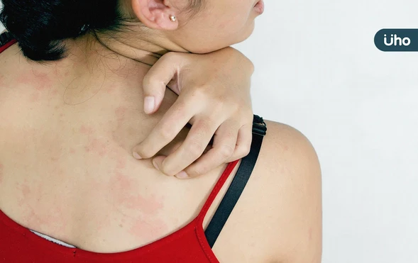 今年首例萊姆病境外移入！北部6旬女紅癢、血尿⋯醫：病程恐拖數年