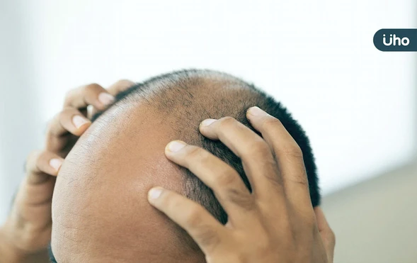 鬼剃頭是什麼？鬼剃頭會自己好嗎？醫揭這些人是好發「圓禿」高風險群