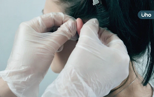 小傷口可能變蟹足腫！女打耳洞「疤痕腫成肉球」醫示警3症狀快就醫